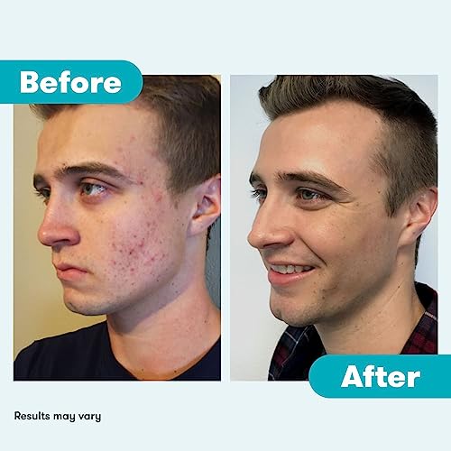 Proactiv 3 Step Acne Treatment - Benzoyl Peroxide Face Wash, Repairing Acne Spot Proactiv Au supplements