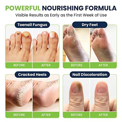 Toenail Fungus Treatment Extra Strength - Advance nail fungus treatment for fingernails FOOT CURE Au supplements