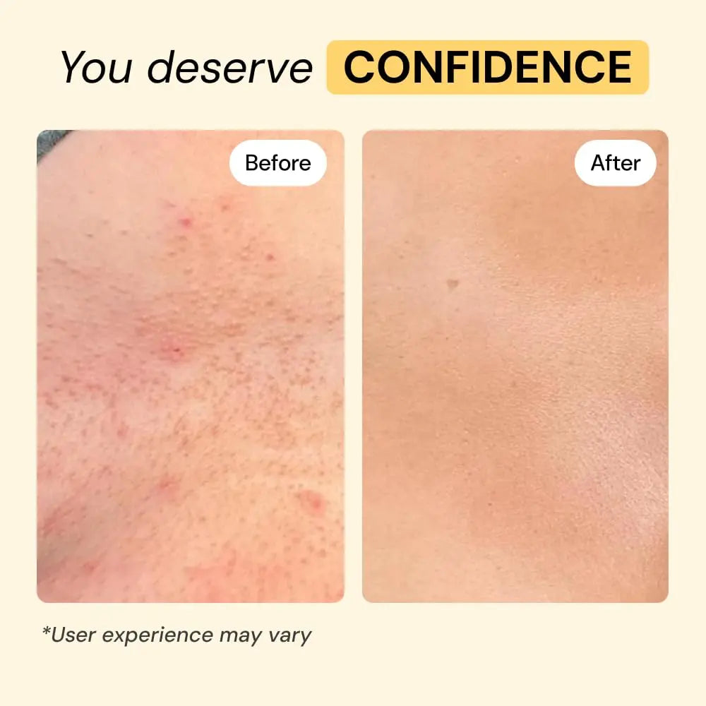 MyMagicHealer Universal Flare Care – Multi-Purpose Solution | Skin Flare-Ups - Hidradenitis Suppurativa, Folliculitis, Boils, Cysts | Anti-Chafing | Irritated Skin Relief w/Propolis & Egg Yolk 1 oz MyMagicHealer Au supplements