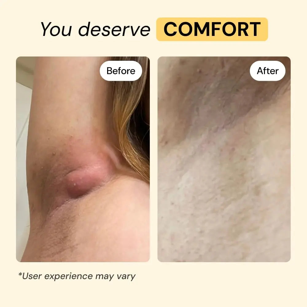 MyMagicHealer Universal Flare Care – Multi-Purpose Solution | Skin Flare-Ups - Hidradenitis Suppurativa, Folliculitis, Boils, Cysts | Anti-Chafing | Irritated Skin Relief w/Propolis & Egg Yolk 1 oz MyMagicHealer Au supplements