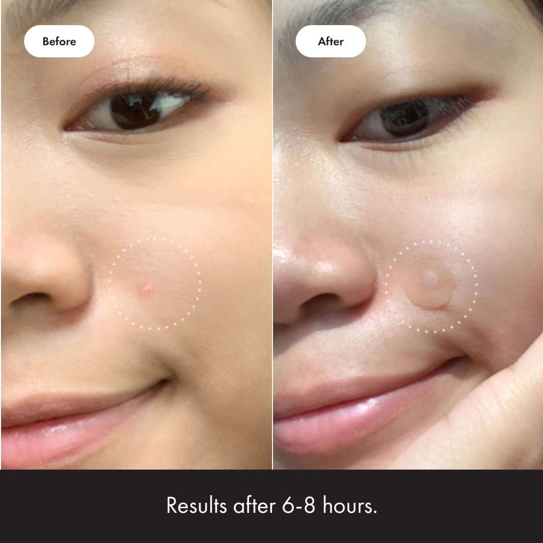 Mighty Patch Original from Hero Cosmetics - Hydrocolloid Acne Pimple Mighty Patch Au supplements