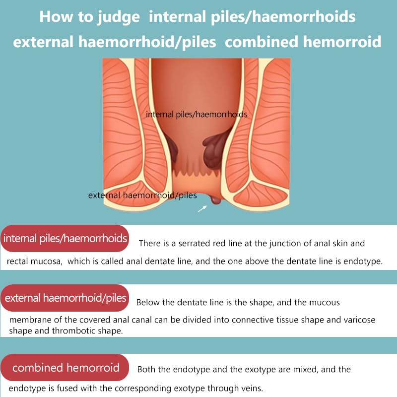 Hemorrhoid Cream for Men and Women, with Lidocaine and Phenylephrine HCl, Provides Fast Relief from hemorrhoid discomfort. Naturally formulated for Hemorrhoids and fissures (0.7 oz) Anisx Au supplements