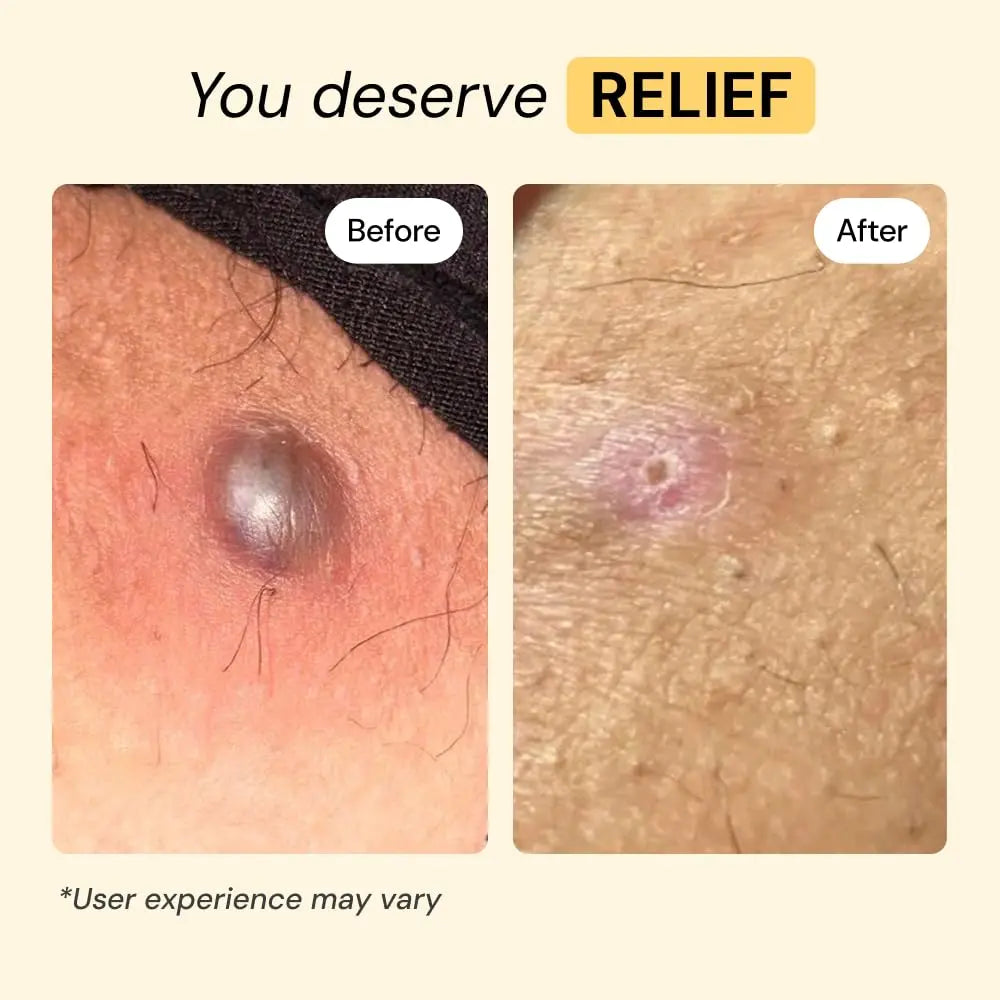MyMagicHealer Universal Flare Care – Multi-Purpose Solution | Skin Flare-Ups - Hidradenitis Suppurativa, Folliculitis, Boils, Cysts | Anti-Chafing | Irritated Skin Relief w/Propolis & Egg Yolk 1 oz MyMagicHealer Au supplements