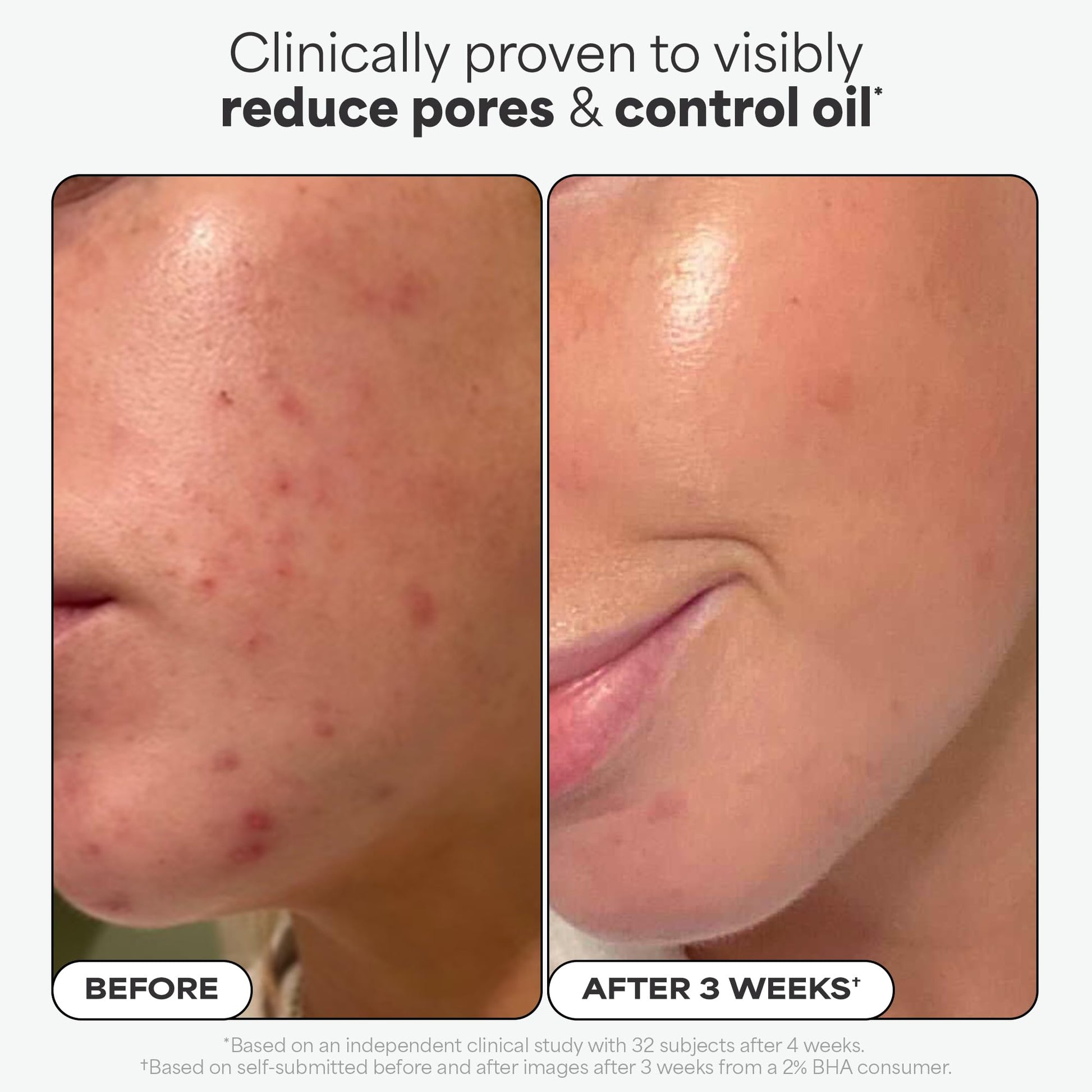 Paulas Choice--SKIN PERFECTING 2% BHA Liquid Salicylic Acid Exfoliant--Facial Exfoliant for Blackheads, Enlarged Pores, Wrinkles & Fine Lines, 4 oz Bottle Paula's Choice Au supplements