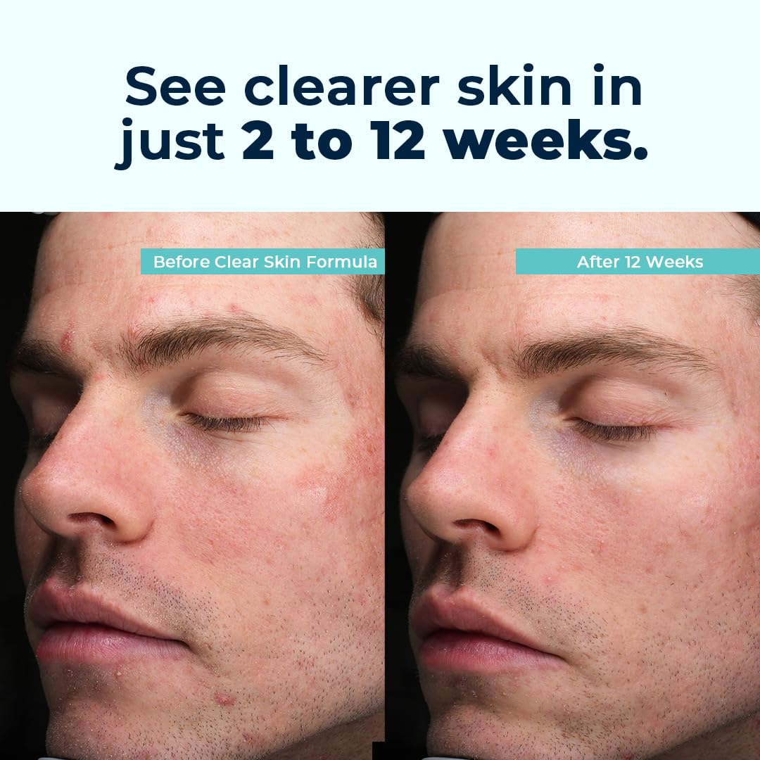 VitaMedica Clear Skin Vitamin Formula | Noncystic Acne Supplement for Skin Clearing | Breakout Treatment for Women and Men | Vitamins A, C, E, Selenium, Chromium, and Zinc for Skin Health | 2 Pack VitaMedica Au supplements