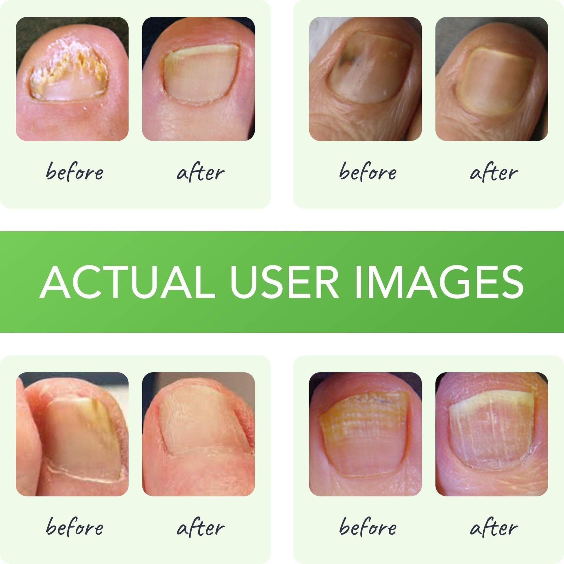 FUNGINIX Healthy Nail Formula - Finger And Toe Fungus Treatment, Made In USA, Foot FUNGINIX Au supplements