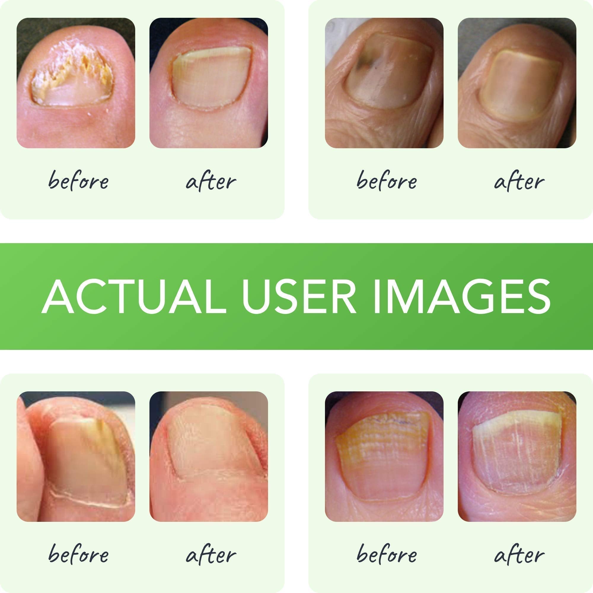 FUNGINIX Healthy Nail Formula - Finger And Toe Fungus Treatment, Made In USA, Foot FUNGINIX Au supplements