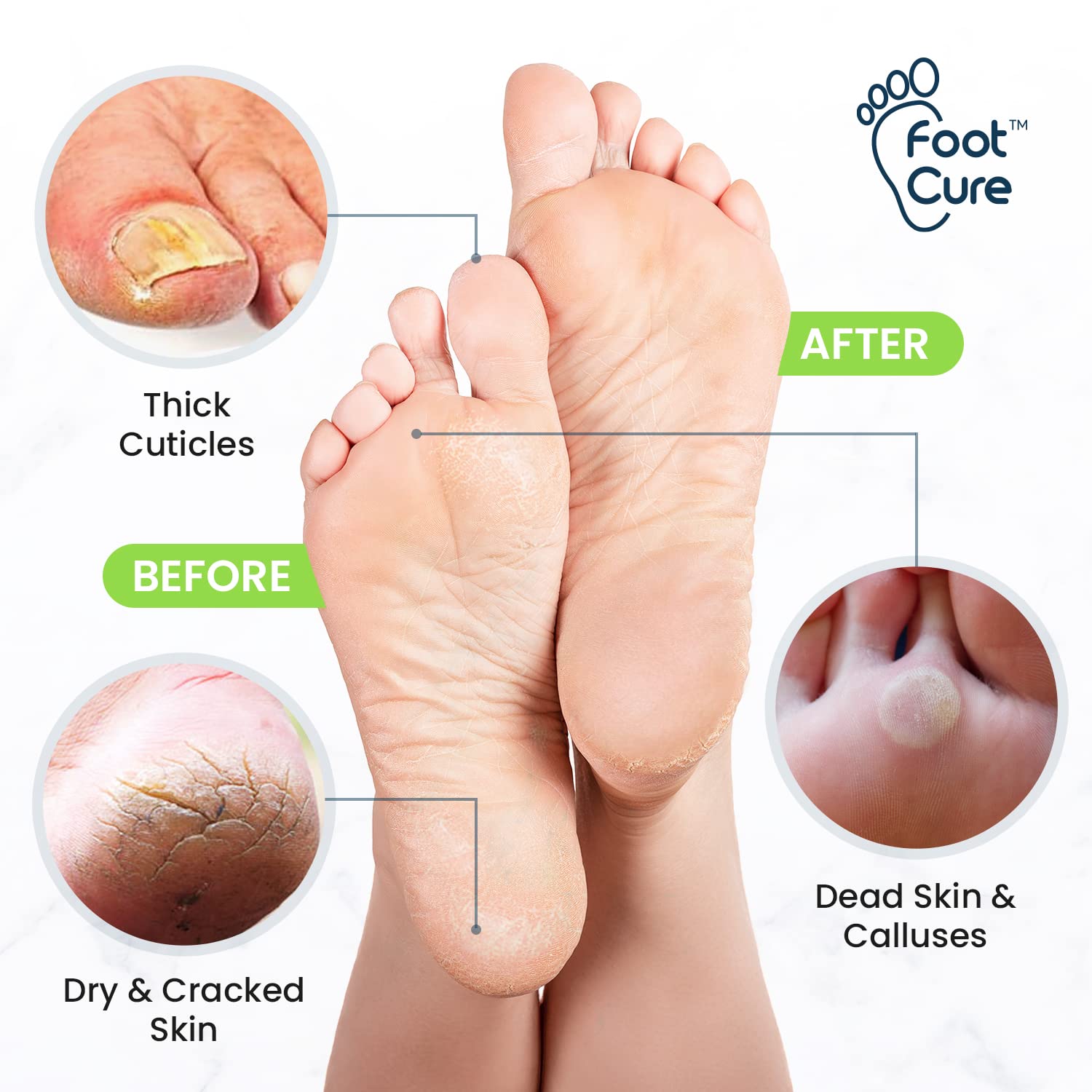 Toenail Fungus Treatment Extra Strength - Advance nail fungus treatment for fingernails FOOT CURE Au supplements