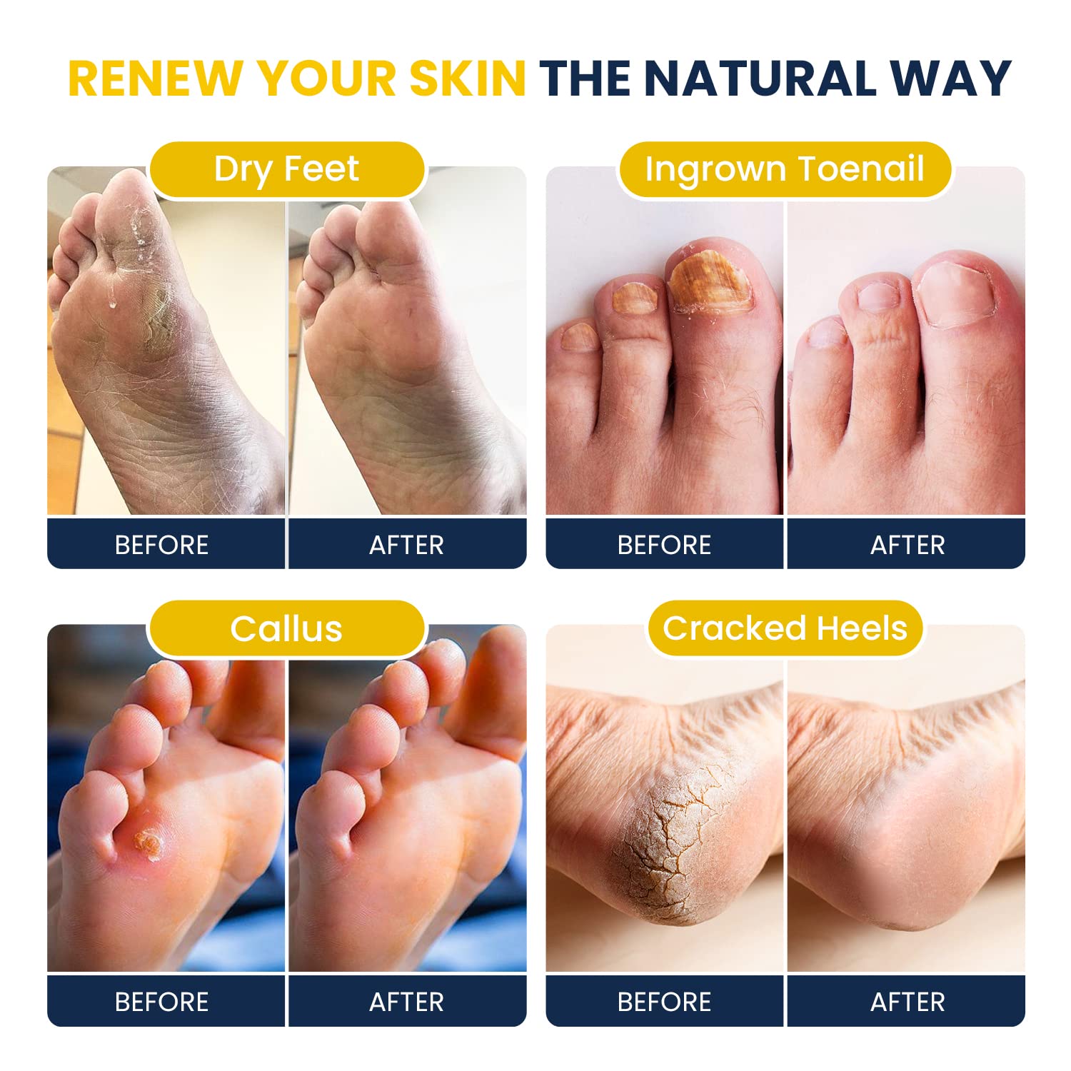 Citrus Detox Foot Soak With Epsom Salts - for Foot Callus, Immune Boost, Damaged Toenail FOOT CURE Au supplements