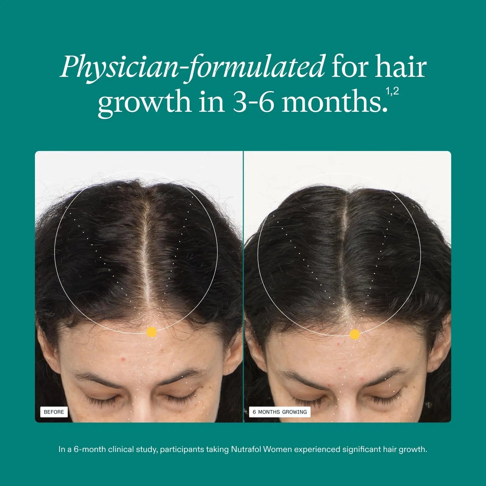Nutrafol Women's Hair Growth Supplements, Ages 18-44, Clinically Proven for Visibly Thicker and Stronger Hair, Dermatologist Recommended - 1 Month Supply Nutrafol Au supplements