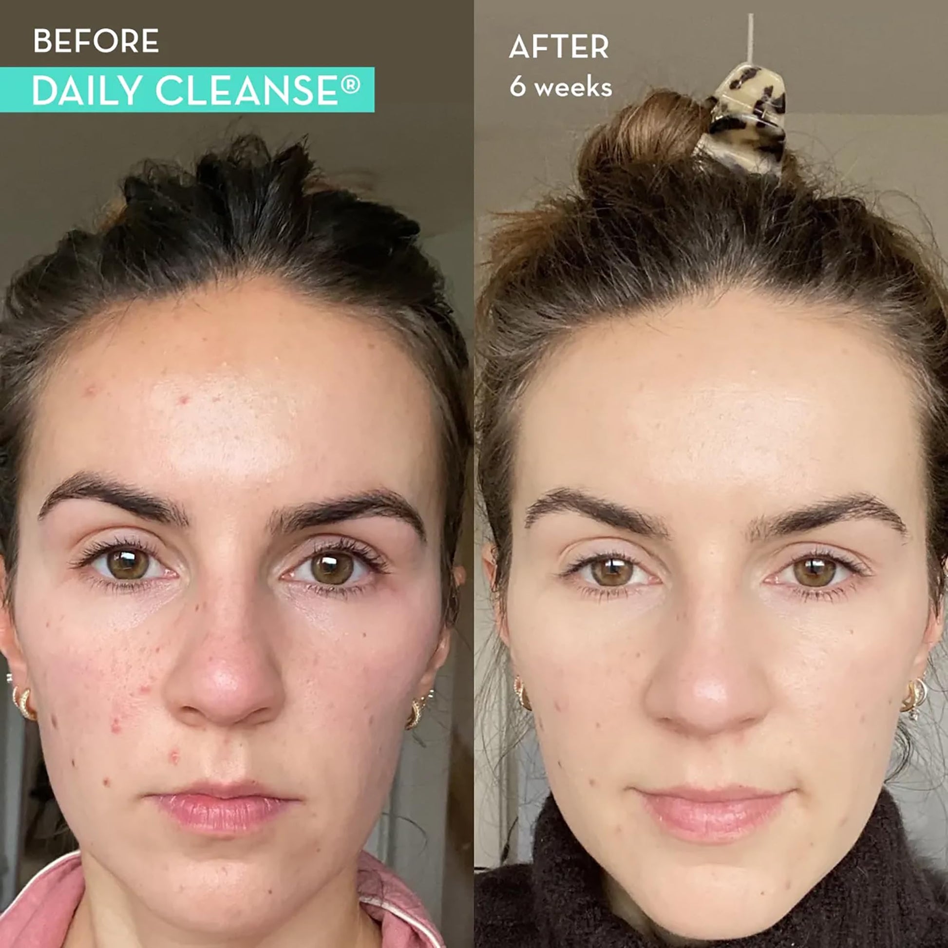 HUM Daily Cleanse Acne Supplements - Support for Clear Skin & Improved Digestion HUM Au supplements