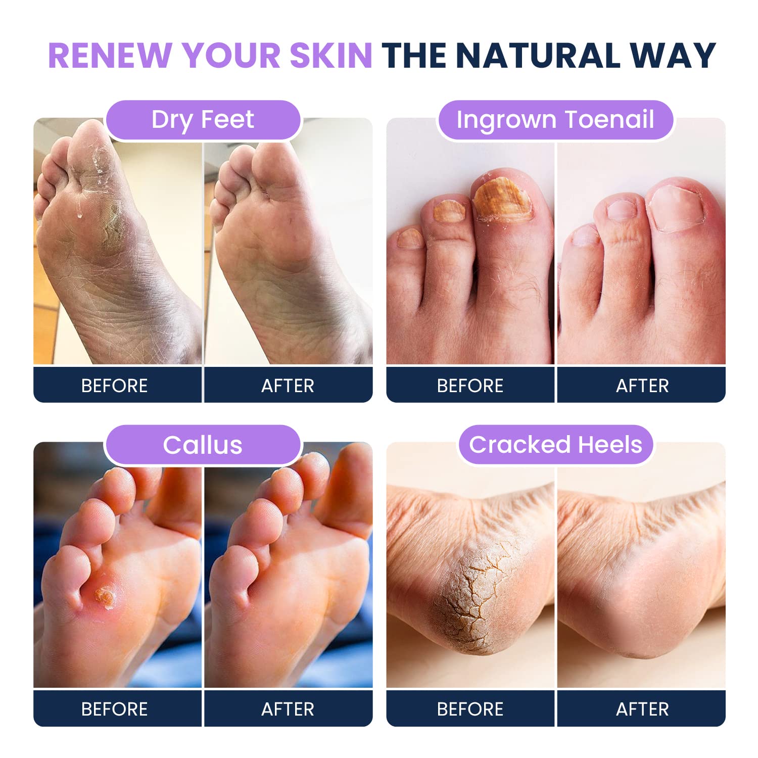 Soothing Lavender Foot Soak with Epsom Salt - Best Toenail Treatment, & Softens Calluses FOOT CURE Au supplements
