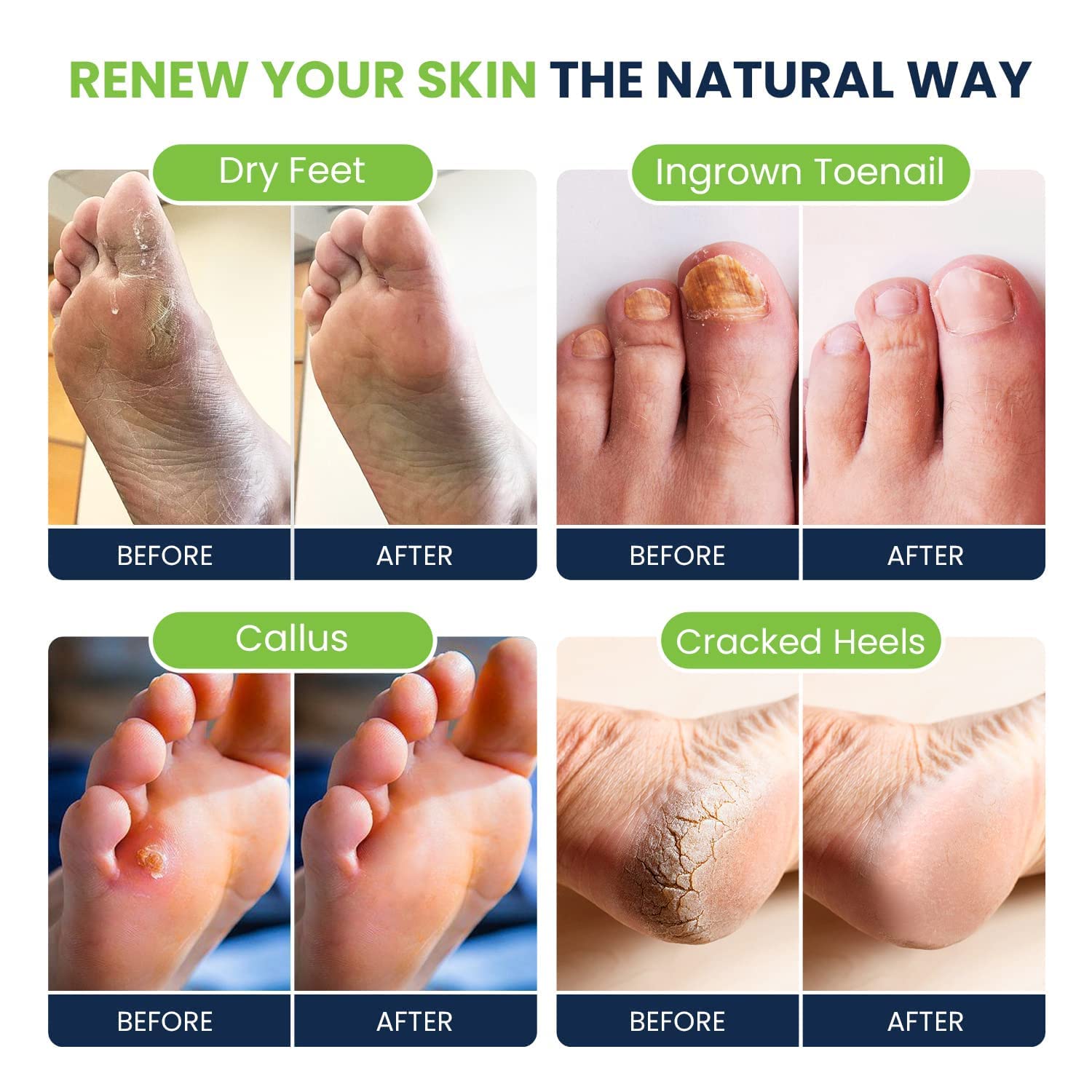 Tea Tree Oil Foot Soak with Epsom Salt - Best Toenail Fungus Treatment, Athletes FOOT CURE Au supplements