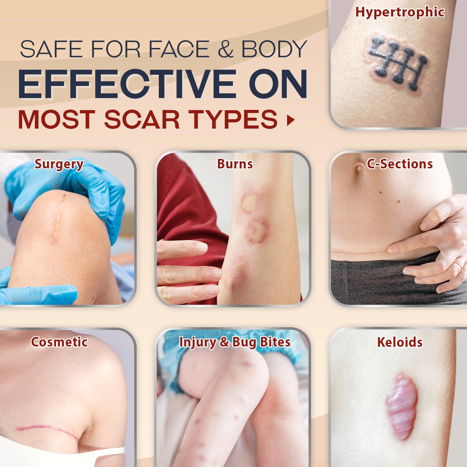 Ebanel Silicone Scar Gel with Allantoin, Emu Oil, Vitamin E and Onion Extract, For Old & New Scars from Surgeries, C-Section, Injuries, Burns & More Ebanel buy supplements Au
