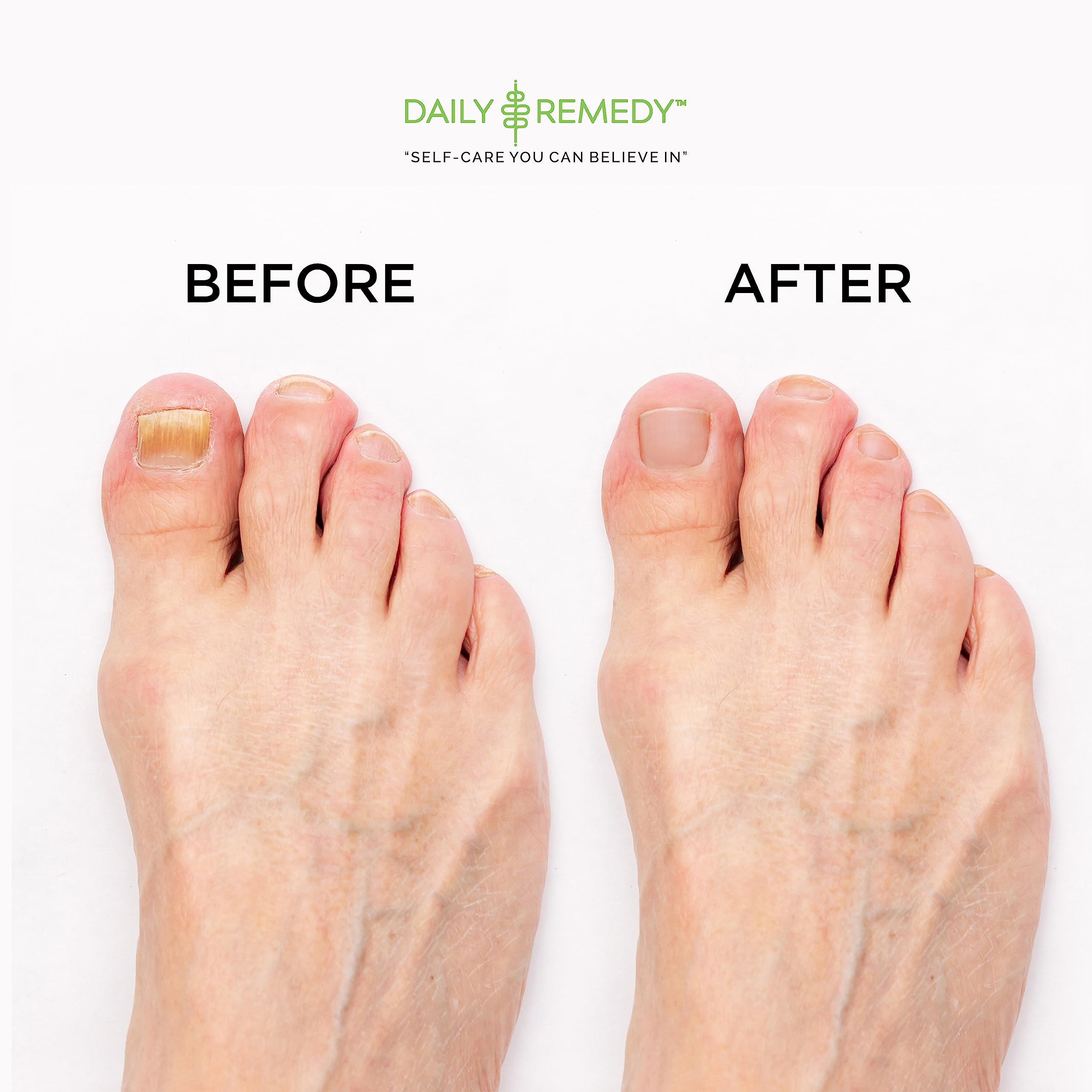 EXTRA STRENGTH Tea Tree Oil Foot Soak with Epsom Salt - Made in USA - for Toenails DAILY REMEDY Au supplements