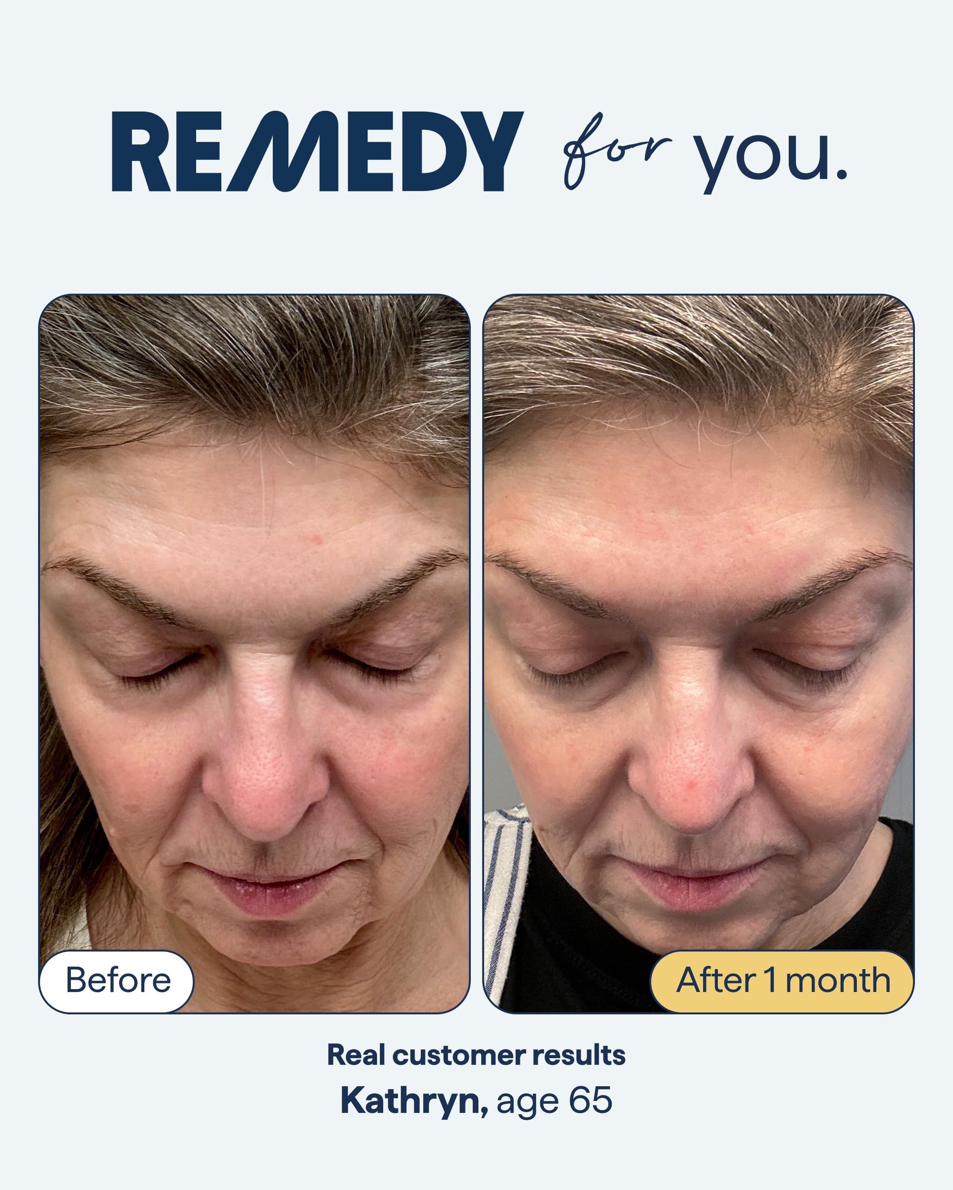 Remedy for Healthy Aging - Retinal, Resveratrol, Glycolic Acid, Argireline, Ferulic Acid, Matrixyl 3000 - Anti-Aging Treatment for Wrinkles, Uneven Texture & Tone - By Dermatologist Dr. Shah Remedy Science Au supplements